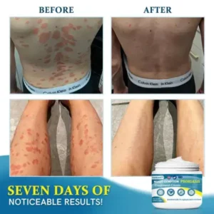 Ourlyard™ Advanced Multi-Symptom Psoriasis Treatment Cream